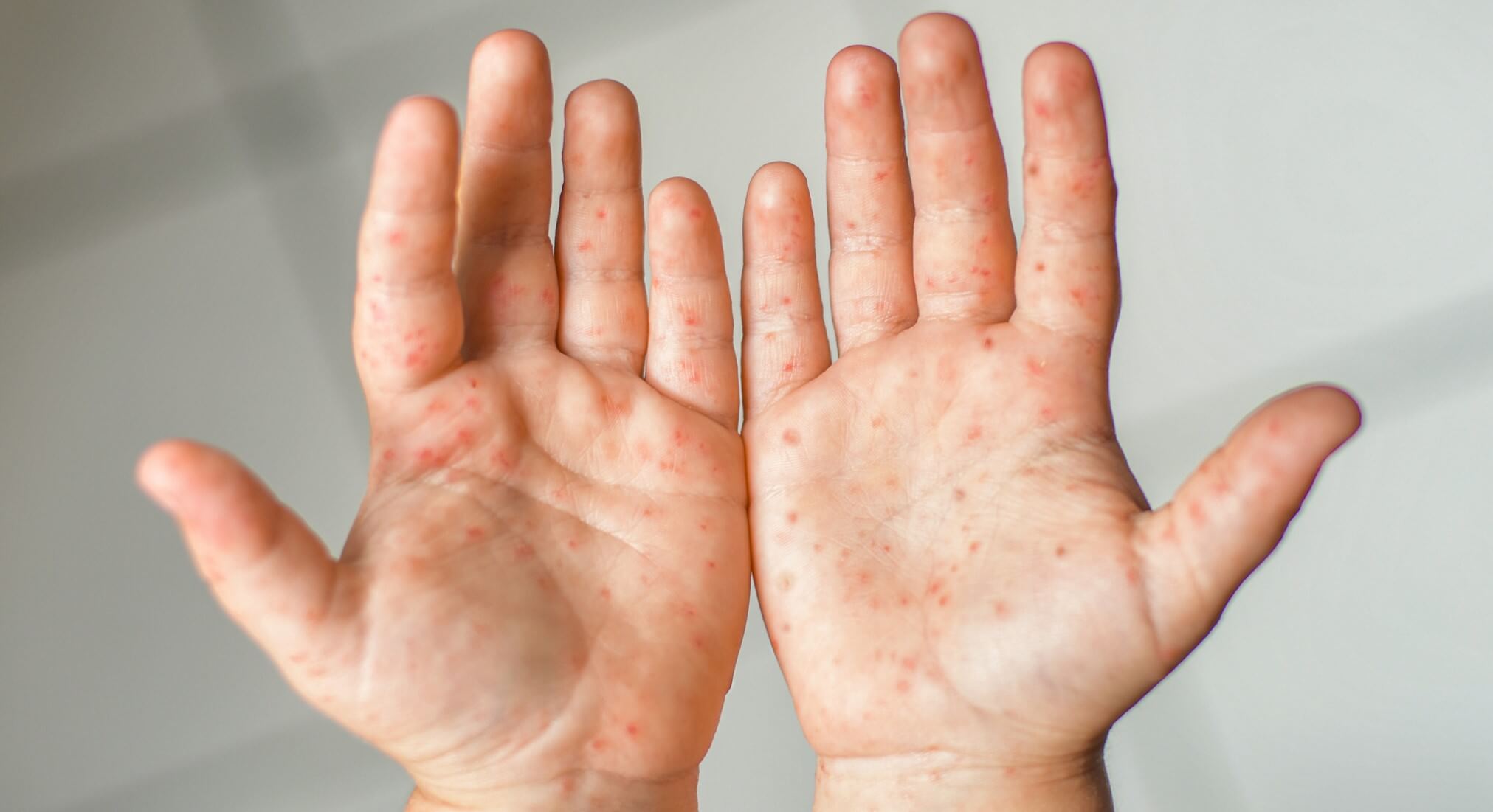 手足口病「戰痘」指南